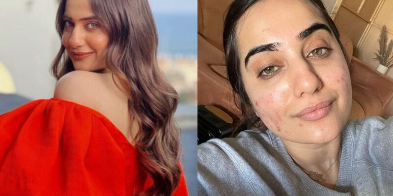 kusha-kapila-reveals-how-she-got-rid-of-acne,-recommends-diet-changes-and-home-remedies