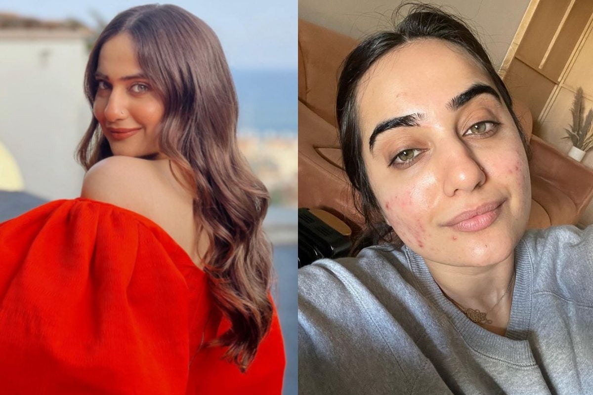kusha-kapila-reveals-how-she-got-rid-of-acne,-recommends-diet-changes-and-home-remedies