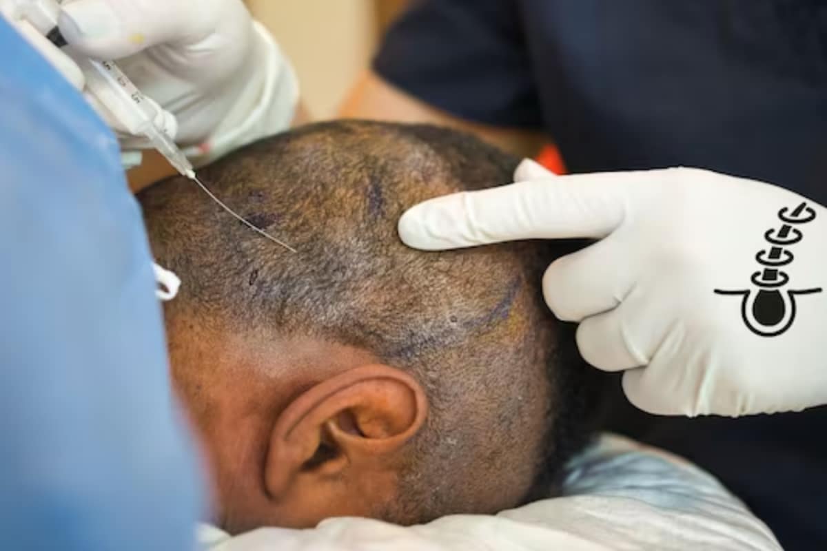 hair-transplant-gone-wrong:-kanpur-man’s-death-sparks-probe-into-clinic’s-safety