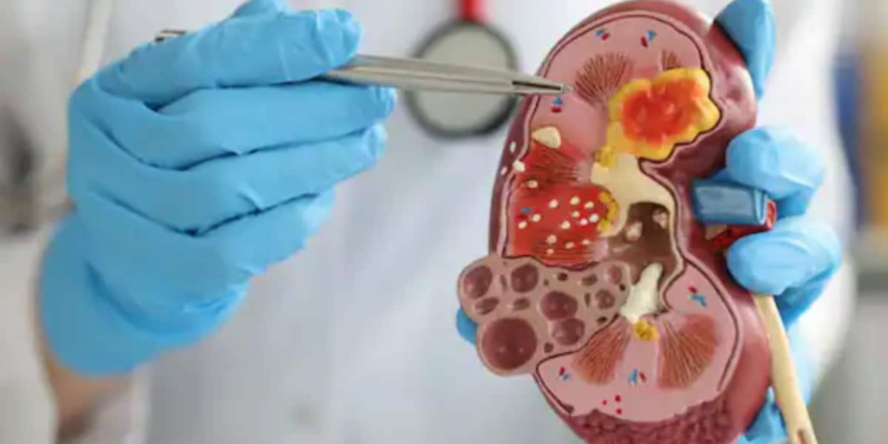 world-kidney-cancer-day:-what-are-the-causes,-symptoms-and-prevention?