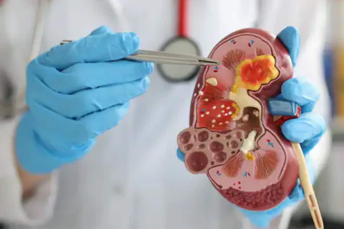 world-kidney-cancer-day:-what-are-the-causes,-symptoms-and-prevention?